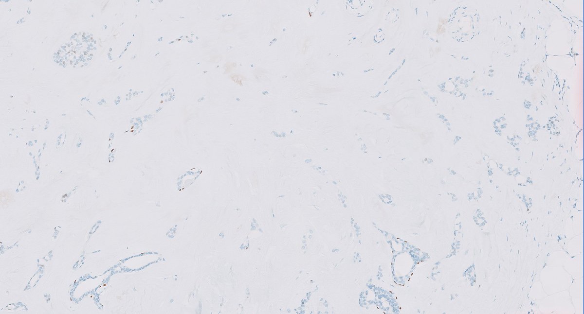 fouad_boulos's tweet photo. Pitfalls of p63: Case 2
This is an imaging-detected mass consisting of small irregular glands in a densely fibrous background. IHC showed marked attenuation and loss of p63 in a majority of glands, raising concern for invasive carcinoma.
What is your diagnosis?
@washu_pathology @washupathedu #breastpath #PathTwitter #PathX