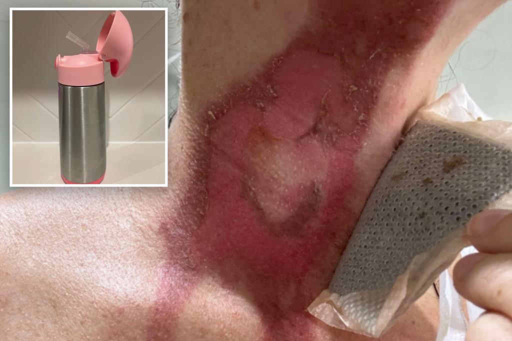 Mom issues dire warning after ‘excruciating’ burn from cleaning insulated water bottle trib.al/OWgF0bO