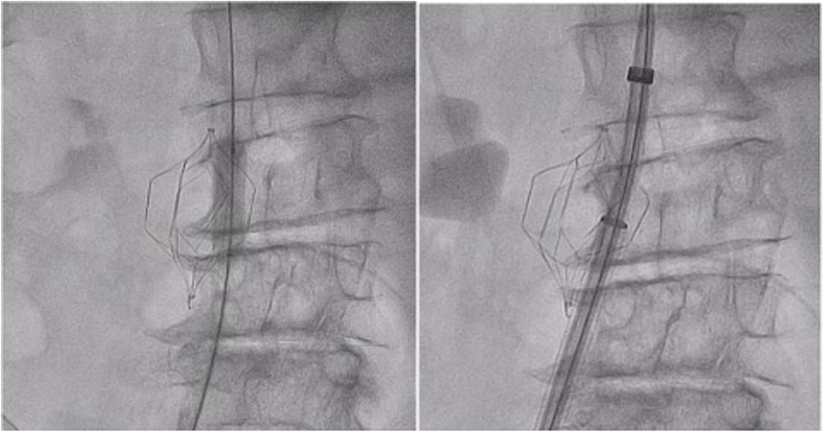 REC Publications (@revespcardiol) on Twitter photo Reparación mitral percutánea a través de filtro de vena cava. #REC #Aheadofprint <a href="/Ifdezherrero/">Ignacio Fernández Herrero</a> <a href="/igomezblazquez/">Iván Gómez Blázquez</a> <a href="/frenandosarnago/">Fernando Sarnago Ceb</a>
revespcardiol.org/es-reparacion-… Reparación mitral percutánea a través de filtro de vena cava. #REC #Aheadofprint <a href="/Ifdezherrero/">Ignacio Fernández Herrero</a> <a href="/igomezblazquez/">Iván Gómez Blázquez</a> <a href="/frenandosarnago/">Fernando Sarnago Ceb</a>
revespcardiol.org/es-reparacion-…