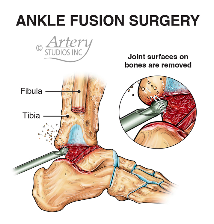 Ankle joint fusion surgery typically involves removal of the degenerated joint surfaces down to bleeding bone. Here, the end of the fibula was removed and fragmented into bone grafting material. This was packed into the joint to allow it to heal in a fused (non-bending) position.