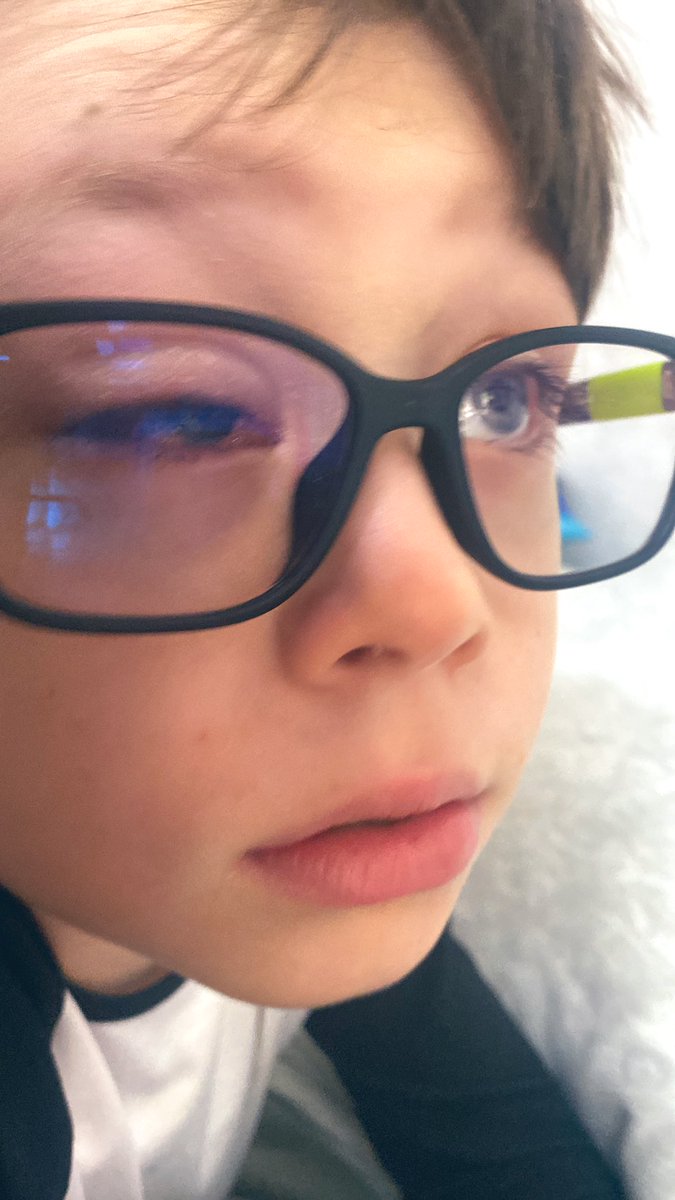cryptomonk_algo's tweet image. Lil Monk Update:

The control with the surgeon went really well, she is an expert in Jacks particular form of strabismus that also affects his muscle mass in his forearms amongst other things . She is very confident his eyes will be straight and healthy! The eye is much less…