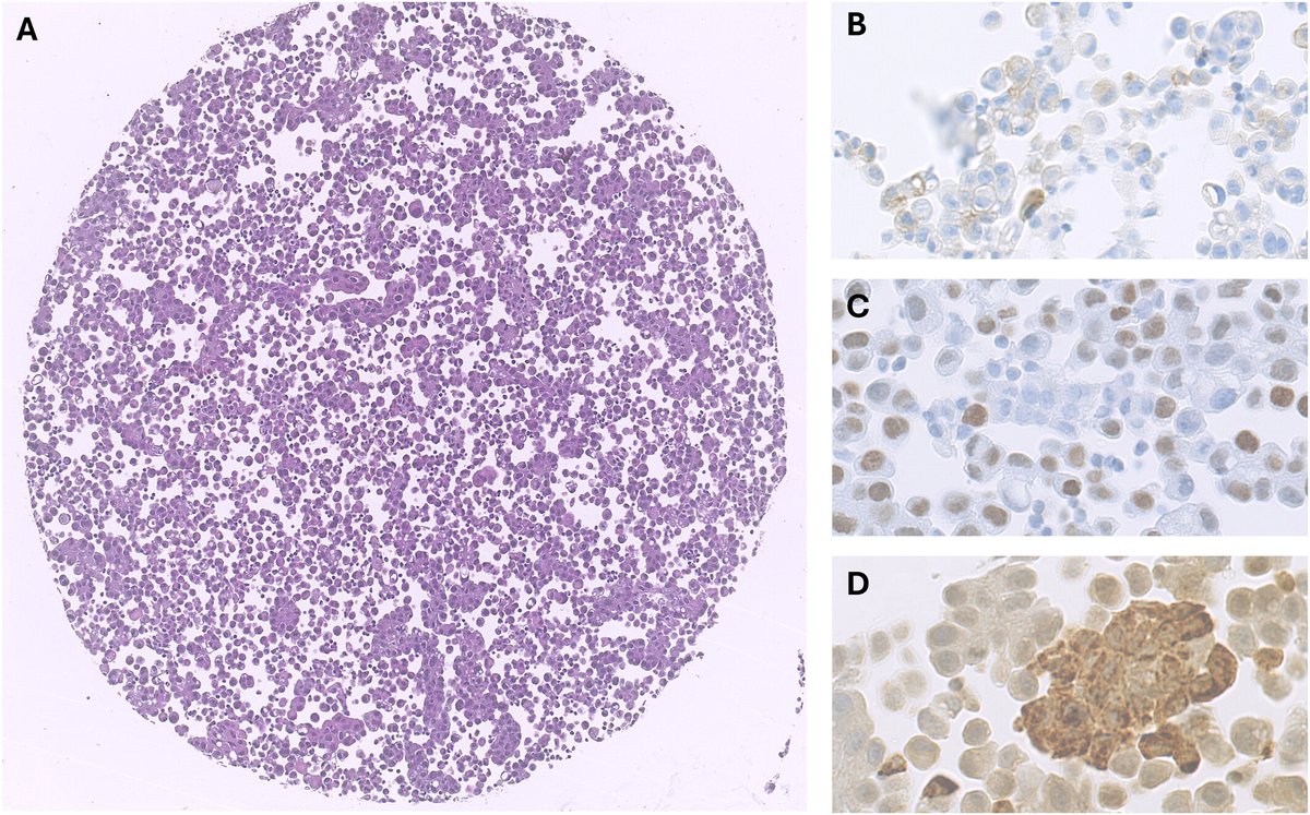 Cancer Cytopathology (@cancercytopath) on Twitter photo New & #OpenAccess | The SAMPLING project: A multi-institutional, international study demonstrates room for improvement in inter-pathologist agreement for PD-L1 evaluation on cytological samples
acsjournals.onlinelibrary.wiley.com/doi/full/10.10…
<a href="/elena_vigliar/">Elena Vigliar</a> <a href="/mtsiddi/">Momin Siddiqui</a> <a href="/Acanfora95/">Gennaro Acanfora, MD</a> <a href="/Sinchita_Roy/">Sinchita Roy MD PhD</a>
#CytoPath New & #OpenAccess | The SAMPLING project: A multi-institutional, international study demonstrates room for improvement in inter-pathologist agreement for PD-L1 evaluation on cytological samples
acsjournals.onlinelibrary.wiley.com/doi/full/10.10…
<a href="/elena_vigliar/">Elena Vigliar</a> <a href="/mtsiddi/">Momin Siddiqui</a> <a href="/Acanfora95/">Gennaro Acanfora, MD</a> <a href="/Sinchita_Roy/">Sinchita Roy MD PhD</a>
#CytoPath