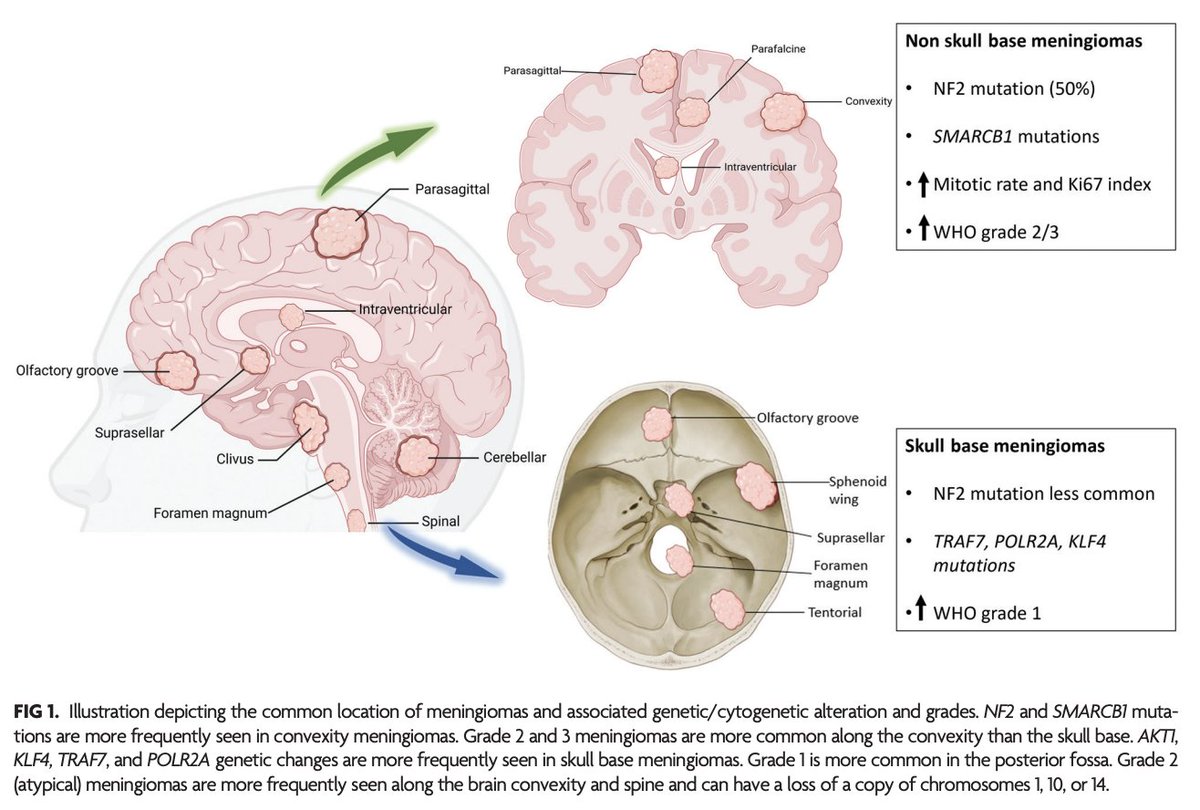 TheAJNR's tweet photo. "Meningioma: Molecular Updates from the 2021 World Health Organization Classification of CNS Tumors and Imaging Correlates"

https://t.co/8h33Pwm0dR

@NeetuSo27437480 https://t.co/orkJsOtqTh