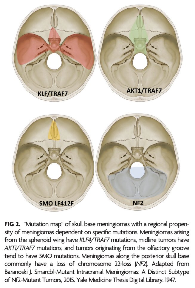 TheAJNR's tweet photo. "Meningioma: Molecular Updates from the 2021 World Health Organization Classification of CNS Tumors and Imaging Correlates"

https://t.co/8h33Pwm0dR

@NeetuSo27437480 https://t.co/orkJsOtqTh