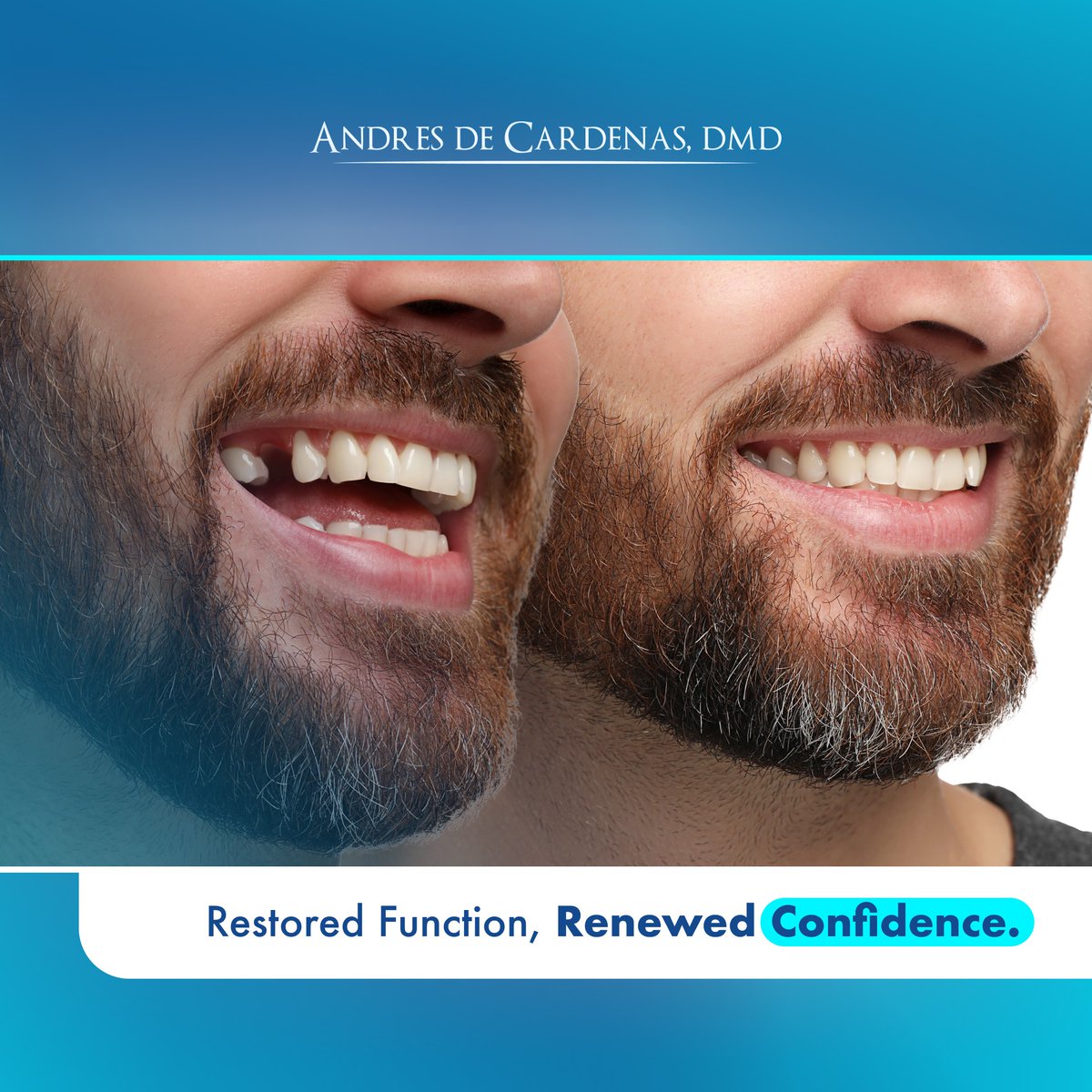 drdecardenas's tweet photo. Replace missing teeth with the gold standard in dental restoration: implants. Durable, natural-looking, and designed to last a lifetime, dental implants restore both function and confidence. Schedule your consultation today. 🦷✨ 
#DentalImplants  #DrAndresDeCardenas https://t.co/pLJM0UdbQI