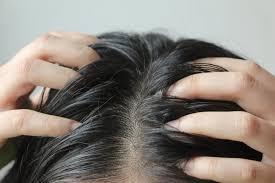 Boringdynasty's tweet photo. Dandruff flakes are dead skin cells shed from the scalp, often due to dry skin, oil buildup, or a yeast-like fungus called Malassezia. Stress or harsh products can worsen it—those white specks are just your scalp’s natural turnover gone rogue! https://t.co/iCVj3iZJGi