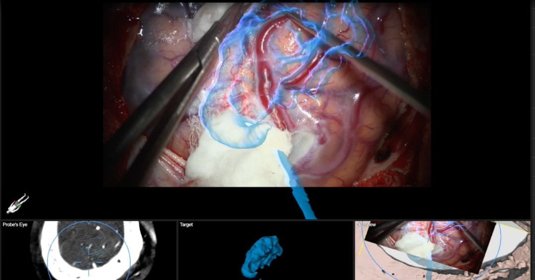 Augmented reality is transforming #neurointervention! This case highlights how IV-DSA-based AR enhances visualization and precision in brain AVM resection while also serving as a powerful tool for medical education. 🔬✨ #MedicalInnovation #NeuroIR #AugmentedReality #SurgicalTech