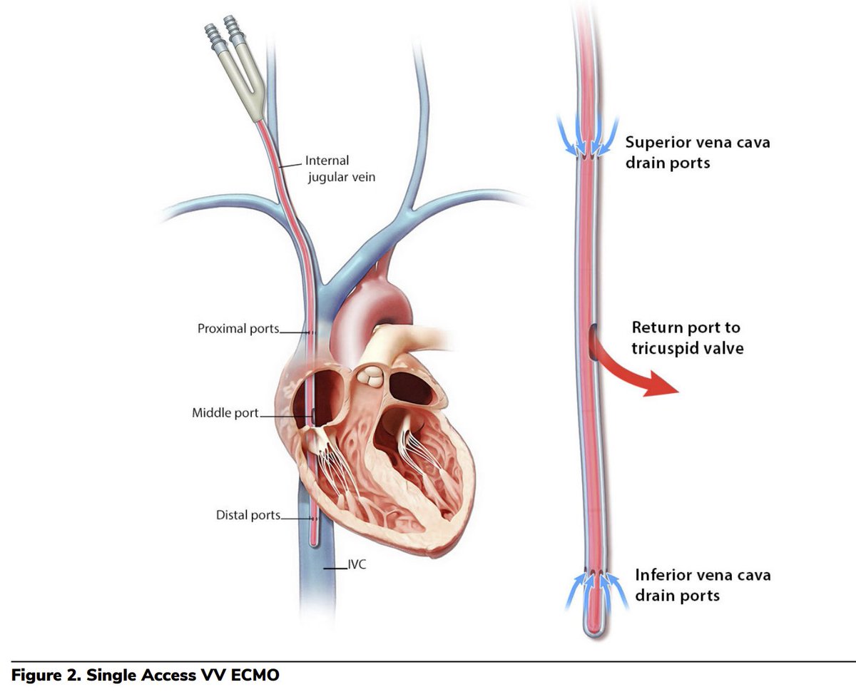 SCAI's tweet photo. 🔗 Ch 18.2: Access Strategies for VV ECMO 2-site vs 1-site Access is everything! #VVECMO is classically configured with double cannulation with one cannula inserted into the right femoral vein and the other inserted into the right internal jugular vein. Bilateral femoral cannulation may be a second-line strategy. This #MCS ebook chapter covers strategies tailored to pt needs, from reducing recirculation to enabling early mobilization.
Download the ebook today ➡️ https://t.co/VffoiPkBkB
#CriticalCare #ECMOTechniques
@rajtayalmd @Jgrewal_12