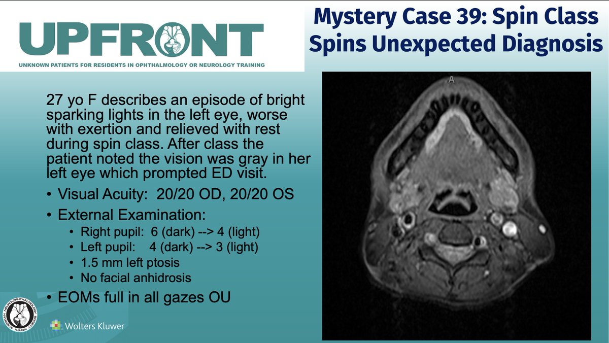 UPFRONT Mystery Case #39 - Spin Class Spins Unexpected Diagnosis: Journal of Neuro-Ophthalmology
Article: bit.ly/JNO_UPFRONT_39 or on bit.ly/JNO_Home
 #brain #eye #vision #research #Neurology #NeuroOphth #Ophthalmology #Medicine