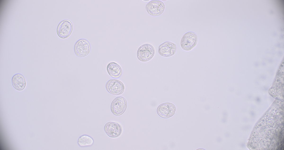 The #Parasite case 771 is now up, donated by Dr. Emily Snaverly: ~1cm long object found on screening colonoscopy. Identification? Answer later this week.
#mayopath #pathology #PathBugs