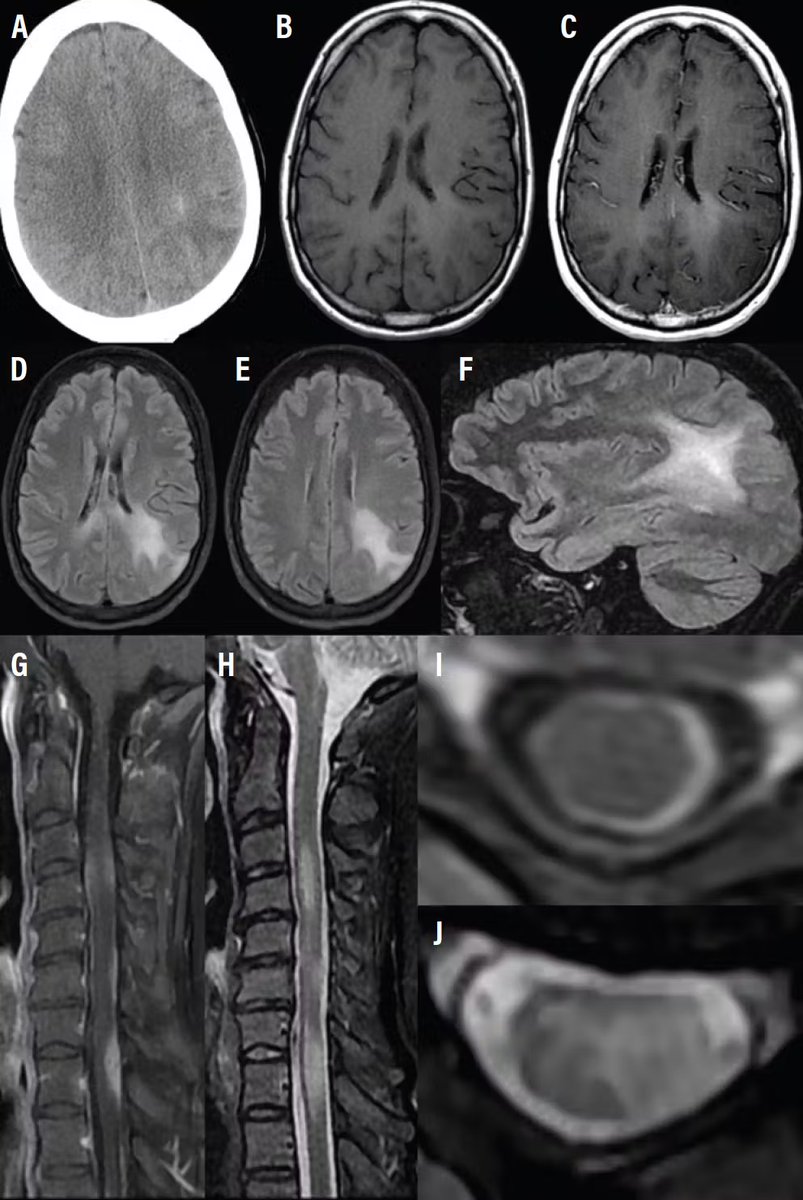 Practical Neurology (@practicalneuro) on Twitter photo The differential diagnosis in the setting of #leptomeningeal enhancement is broad.
Read a case report about a patient presenting with expressive #aphasia, visual disturbances, and #headache by Drs. Primdahl, Jamshidi (<a href="/PJamshidi_MD/">Pouya Jamshidi, MD</a>), Ahrendsen (<a href="/JaredAhrendsen/">Jared T. Ahrendsen MD, PhD (AP/NP/FP)</a>), Kothari The differential diagnosis in the setting of #leptomeningeal enhancement is broad.
Read a case report about a patient presenting with expressive #aphasia, visual disturbances, and #headache by Drs. Primdahl, Jamshidi (<a href="/PJamshidi_MD/">Pouya Jamshidi, MD</a>), Ahrendsen (<a href="/JaredAhrendsen/">Jared T. Ahrendsen MD, PhD (AP/NP/FP)</a>), Kothari