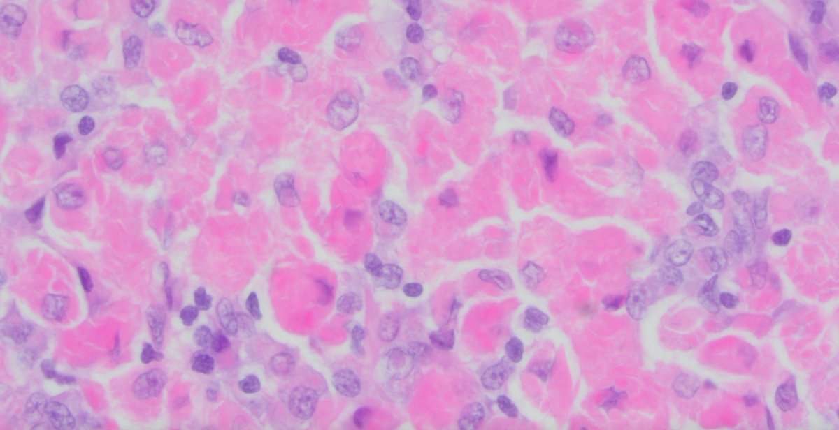 SibaElHussein's tweet photo. Symptomatic generalized lymphadenopathy involved by crystal storing histiocytosis (histiocytes with cytoplasmic immunoglobulin)

#hemepath #lymsm #mmsm #pathX #PathTwitter #MedeD #Surgpath https://t.co/kY5wAvYJ3B