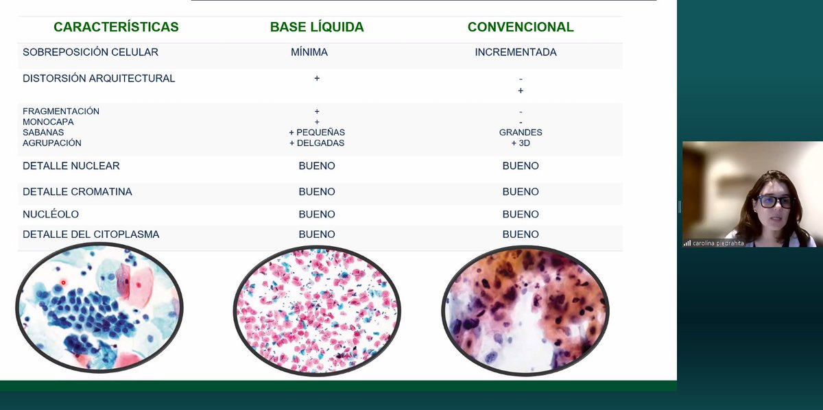 MonicaGarciaBuitrago (@monicagarciabu2) on Twitter photo First #Cytopathology session in NonNeoplastic Gyn Cytology with Dr Carolina Piedrahita! Learn key diagnostic tips.
Primera sesión revisando #Citología Ginecológica No Neoplásica! con tips dx 🧐🔬<a href="/UMiamiPathology/">UMiami Pathology</a> <a href="/CarmenGomezMD/">Carmen Gomez-Fernandez, MD</a> <a href="/MerceJorda1/">Merce Jorda</a> <a href="/MI_FUCS/">Fundación Universitaria de Ciencias de la Salud</a> <a href="/martin_poveda82/">Martin Poveda</a> <a href="/jalithsoler/">IVONNE JALITH SOLER CALVO</a> First #Cytopathology session in NonNeoplastic Gyn Cytology with Dr Carolina Piedrahita! Learn key diagnostic tips.
Primera sesión revisando #Citología Ginecológica No Neoplásica! con tips dx 🧐🔬<a href="/UMiamiPathology/">UMiami Pathology</a> <a href="/CarmenGomezMD/">Carmen Gomez-Fernandez, MD</a> <a href="/MerceJorda1/">Merce Jorda</a> <a href="/MI_FUCS/">Fundación Universitaria de Ciencias de la Salud</a> <a href="/martin_poveda82/">Martin Poveda</a> <a href="/jalithsoler/">IVONNE JALITH SOLER CALVO</a>