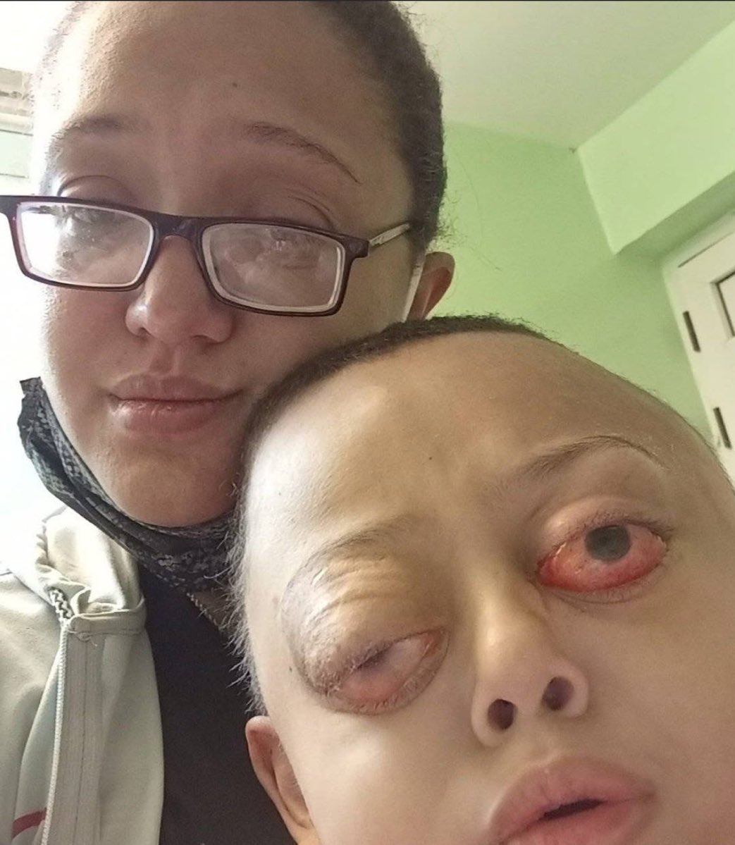 UHN_Plus's tweet image. 🇨🇺🇺🇸 | URGENTE — ¡Máxima difusión por favor!

Damir Ortiz Ramírez, un niño cubano de apenas 10 años con neurofibromatosis tipo 1, lucha por su vida en terapia intensiva del Hospital Juan Manuel Márquez en La Habana, mientras la Embajada de EE.UU. le cierra las puertas al negarle…