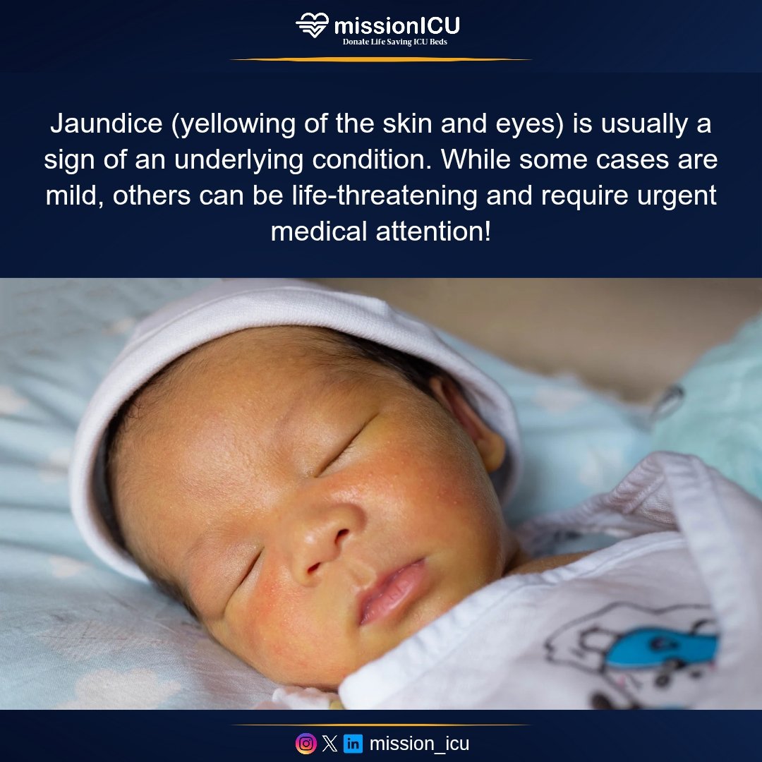 mission_icu's tweet photo. Jaundice in newborns, pregnant women, or immunocompromised individuals also requires urgent evaluation.  

Tag &amp; Share to spread awareness! Stay informed, stay safe! 

#Jaundice #MedicalEmergency #LiverHealth #DoctorAdvice #HealthAwareness #EmergencyCare #Hepatitis #Bilirubin https://t.co/wuk8Ru3Qqb