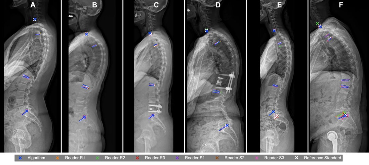 Hoppe et al. show that automated #Spinopelvic measurements on #Radiographs with #AI are accurate within the variability of experienced readers, but with the potential to save time and increase reproducibility. #LMUradiology

doi.org/10.1007/s11547…