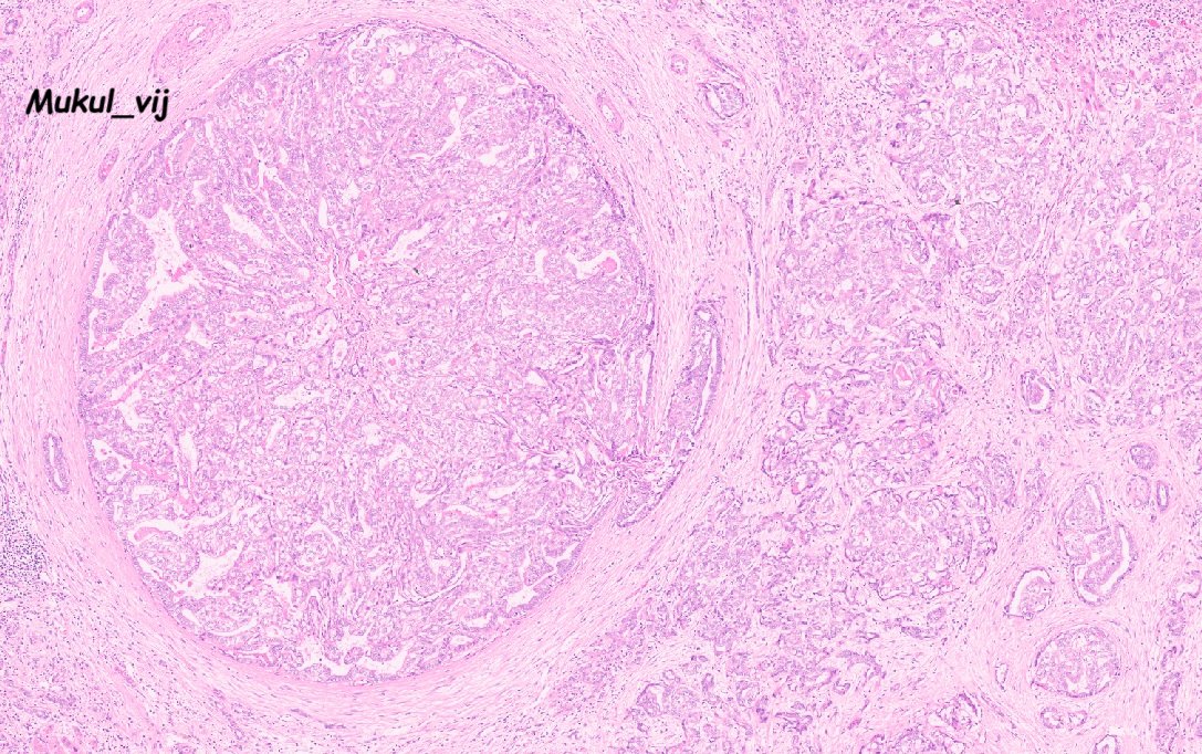 Super rare biliary tumour
Intraductal tubular neoplasms of the bile duct (ITPN) with invasive adenocarcinoma (small duct type)
MUC6 positive
#liverpath #pathx #pathology