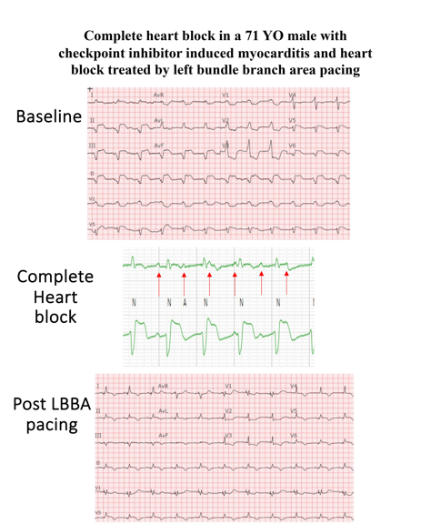 ESC_Journals's tweet photo. Successful management of complete heart block in checkpoint inhibitor induced myocarditis by left bundle branch area pacing https://t.co/PmDbE8z2lM

#EHJCaseReports @Phiso_de @TJ_Yeo @aayshacader @BoldiKovacsMD @KardiologieHH @ANazmiCalik @O_Azizy_MD @saramoscatelli7 @EHJCREiC https://t.co/Ucj4HE1J6U