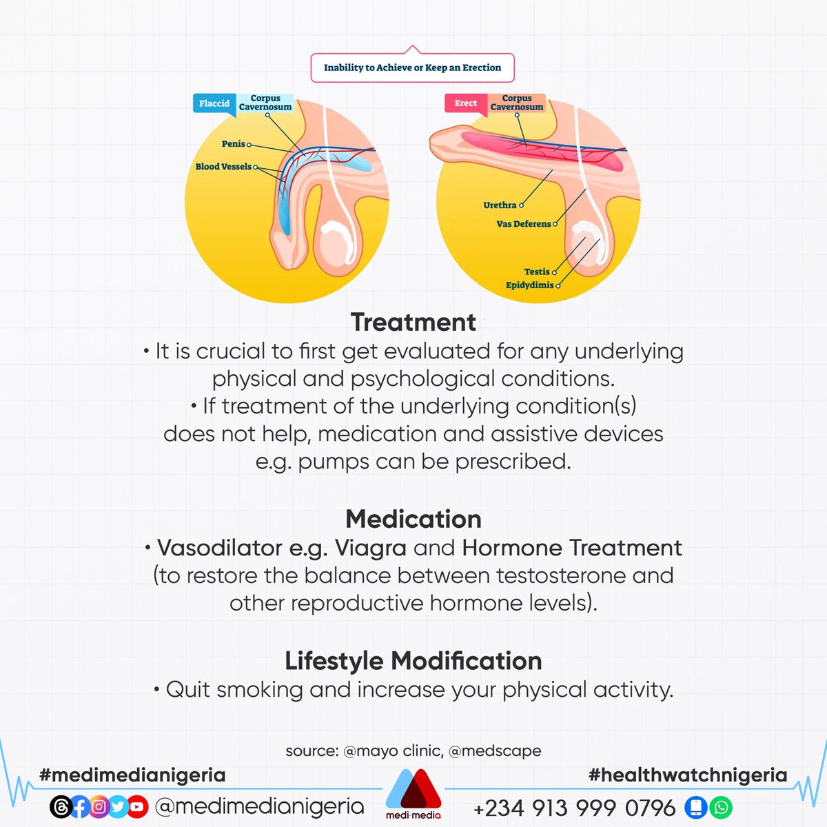 MediMediaNG's tweet photo. Erectile dysfunction, also known as impotence, is defined by difficulty getting and keeping an erection.

#medimedianigeria #healthforall #healthwatchnigeria #nigeria #menshealth #sexualhealth #ed #testosterone #health #libido #sex #viagra #impotence #erectile #penis #bettersex https://t.co/muIs3gh8Kf