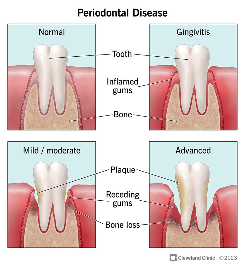 Study Explores Fatty Acids’ Impact On Gum Disease:

Results indicated positive associations with specific saturated, monounsaturated, and polyunsaturated fatty acids, while others, like omega-6, showed negative associations.

More info: jada.ada.org/article/S0002-…