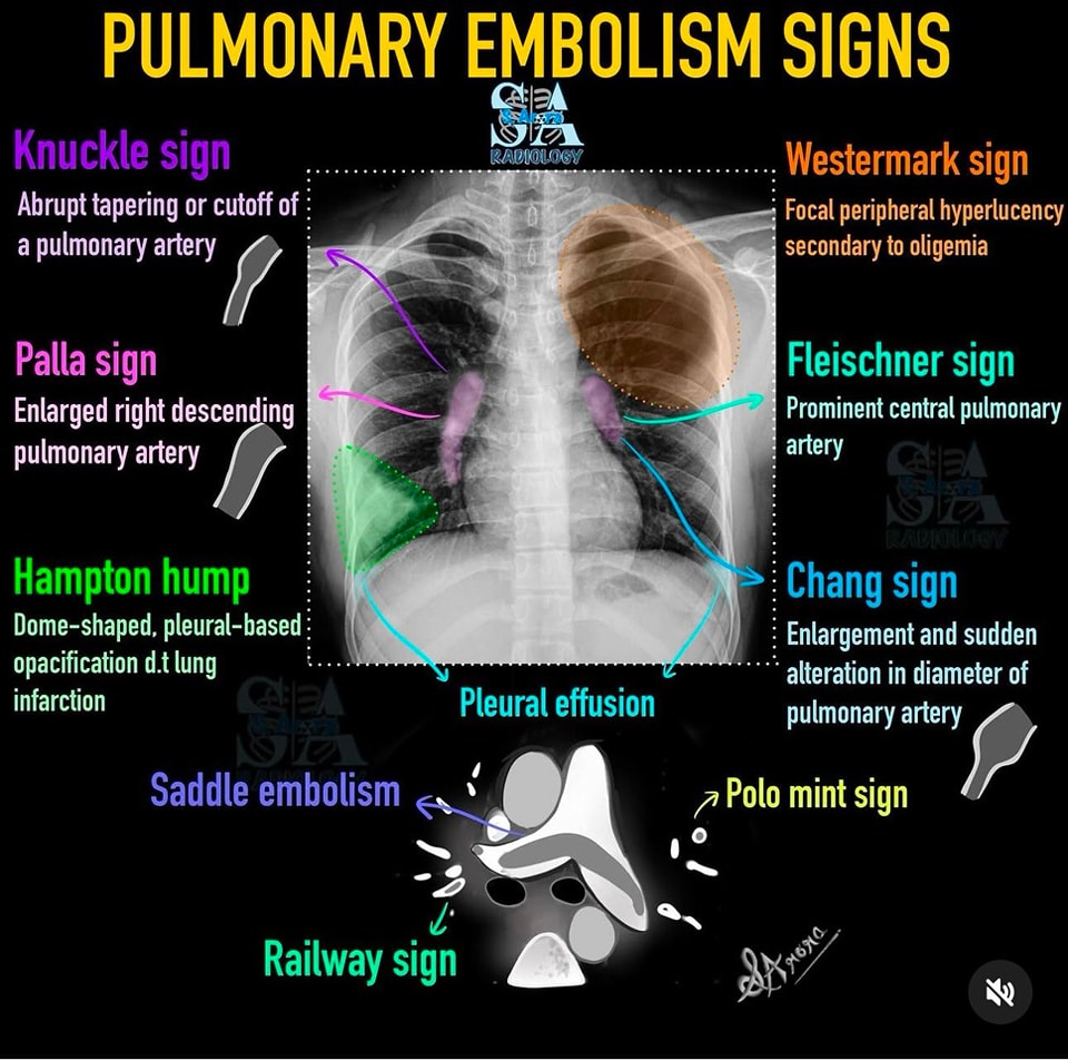 🔴Pulmonary Embolism Chest CT and X- ray Signs⤵️ 🔹

 #Cardiology #FOAMed #MedEd #medstudent #paramedic #Cardiology #CardioEd #medtwitter #meded #CardioTwitter #cardiotwiteros  #MedX #cardiovascular #MedTwitter #medical #medEd #cardiotwitter #medicineball
