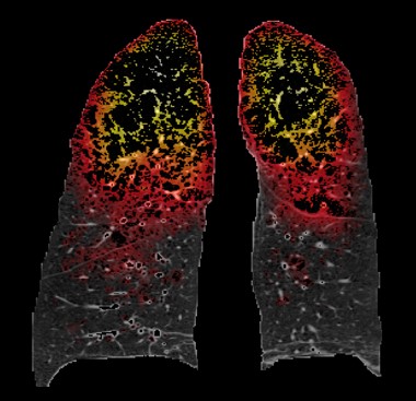 Surya P Bhatt, MD, MSPH (@suryapbhatt) on Twitter photo 1/2 New pub in <a href="/ATSBlueEditor/">ATS Blue Journal</a> We challenge the paradigm that all emphysema results from small airway disease. We show that most new emphysema arises from areas of high Mechanically Affected Lung (MAL) and in substantially higher proportion than areas of small airways disease. 1/2 New pub in <a href="/ATSBlueEditor/">ATS Blue Journal</a> We challenge the paradigm that all emphysema results from small airway disease. We show that most new emphysema arises from areas of high Mechanically Affected Lung (MAL) and in substantially higher proportion than areas of small airways disease.