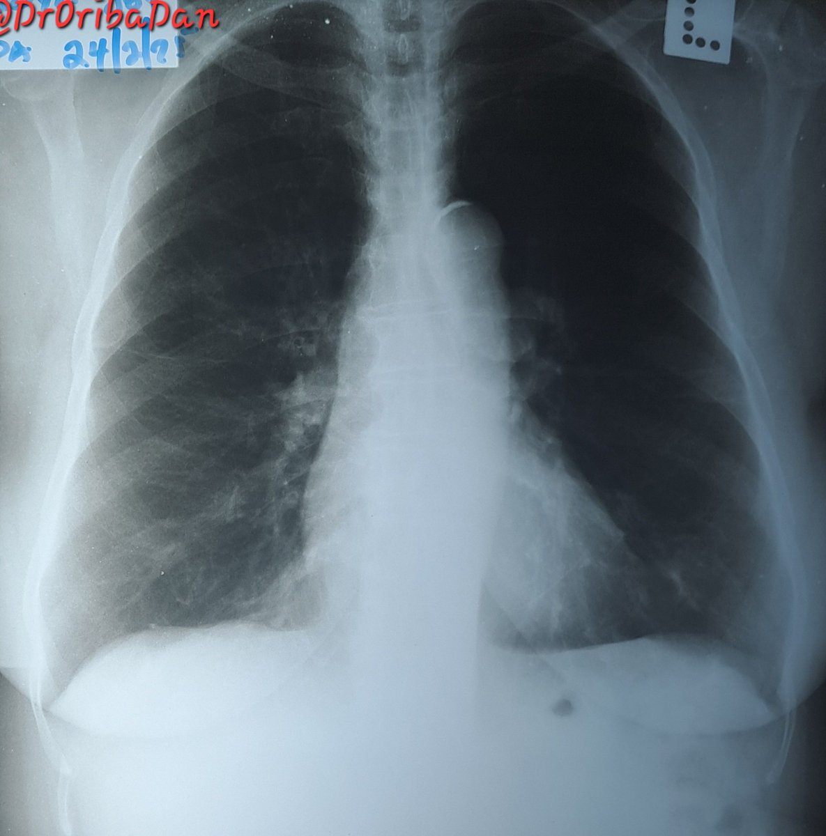 Case Discussion🏥

🚑A 49y/F presents with a persistent, bothersome non-productive cough, dyspnea, &amp; palpitations 

☢️Interpret the X-ray: What findings stand out?
⁉️What is the most likely diagnosis?
✍️How would you approach this case?

🤔Drop your thoughts below! ⬇️