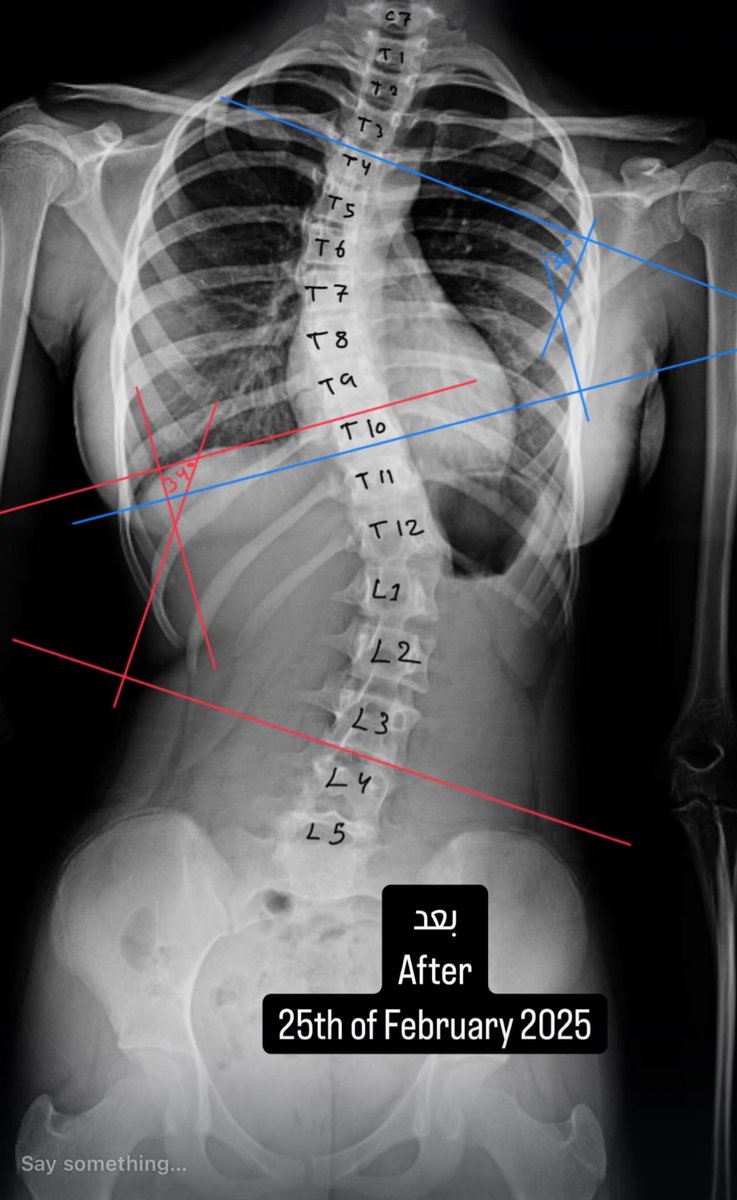 fawaz_physio's tweet photo. الالتزام، الالتزام، الالتزام!!! 
الحمدلله النتايج حلوة في خطة علاجية تقريباً ٦ شهور. 
علاج #الجنف هي رحلة علاجية تدار من فريق طبي متخصص متكامل وليس جهد فردي. 
نزول درجة من ٤٧ إلى ٣٤ في الانحناء القطني
ومن ٤٢ إلى ٣٦ في الانحناء الصدري 
طبعا الأرقام في الاشعه تعتبر تقريبية وليست دقيقة 
لكن تعطي انطباع عام.