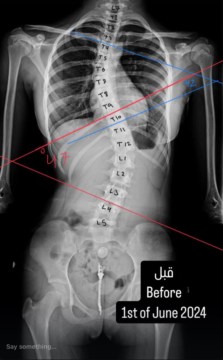 fawaz_physio's tweet photo. الالتزام، الالتزام، الالتزام!!! 
الحمدلله النتايج حلوة في خطة علاجية تقريباً ٦ شهور. 
علاج #الجنف هي رحلة علاجية تدار من فريق طبي متخصص متكامل وليس جهد فردي. 
نزول درجة من ٤٧ إلى ٣٤ في الانحناء القطني
ومن ٤٢ إلى ٣٦ في الانحناء الصدري 
طبعا الأرقام في الاشعه تعتبر تقريبية وليست دقيقة 
لكن تعطي انطباع عام.