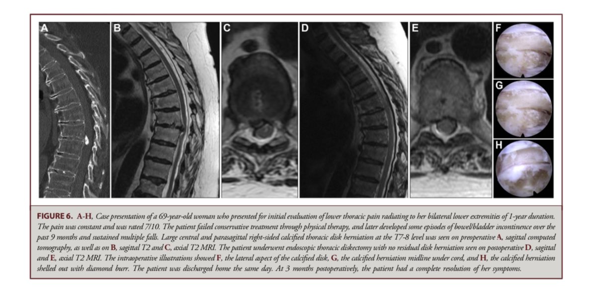 Check out the latest from Operative Neurosurgery: Open Versus Endoscopic Approach for Thoracic Disk Herniations from <a href="/gardocki_ray/">Ray Gardocki</a> <a href="/HaniChanbour/">Hani Chanbour MD</a> <a href="/BFStephensMD/">Byron Stephens, MD, MSCI</a> et al. Great work!

<a href="/CNS_Update/">CNS</a> <a href="/NeurosurgeryCNS/">Neurosurgery Publications</a> <a href="/DKondziolkaCNS/">Douglas Kondziolka</a> 

journals.lww.com/onsonline/abst…