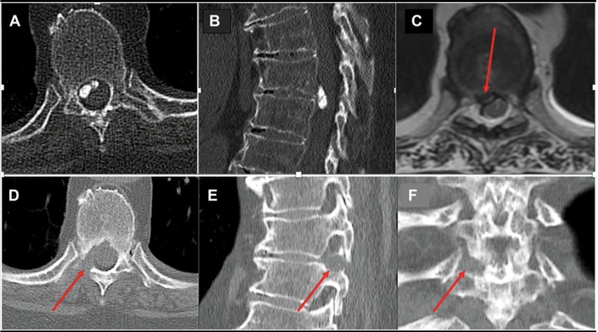 #ONSNew Open Versus Endoscopic Approach for Thoracic Disk Herniations: Equivalent Short-Term Outcomes With Significantly Different Costs bit.ly/3XlQpaq by <a href="/CampbellLiles/">Campbell Liles, MD</a> et al Vanderbilt University Medical Center <a href="/JohnHShinMD/">John H. Shin MD, MBA</a> <a href="/CNS_Update/">CNS</a> <a href="/DKondziolkaCNS/">Douglas Kondziolka</a>