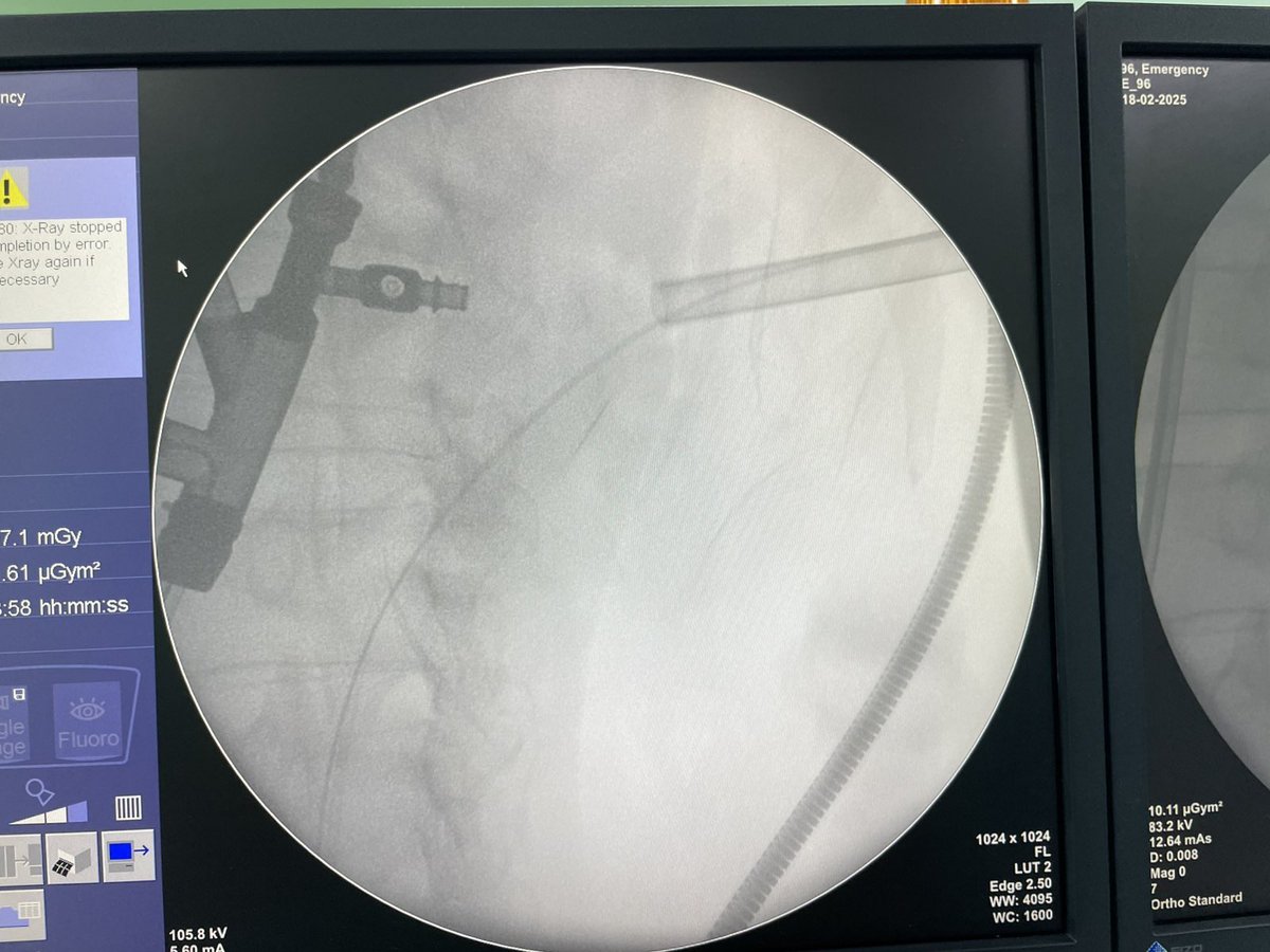 #SupineMPerc, #upperpole, #antegrade #decreasepuncture
<a href="/endouroacademy/">Endourology Academy</a> <a href="/NAUS_NepUro/">NAUS</a> <a href="/SKPal04031957/">S K Pal</a> <a href="/EndourologyT/">T&T Endourology</a> <a href="/Endo_Society/">Endourological Society</a>