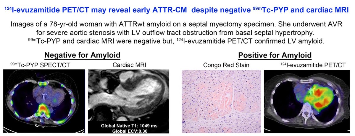 CircImaging (@circimaging) on Twitter photo 2/ A new <a href="/CircImaging/">CircImaging</a> case suggests ¹²⁴I-evuzamitide PET/CT might detect early disease even when traditional imaging fails. <a href="/DorbalaSharmila/">Sharmila Dorbala</a> <a href="/BWHAmyloid/">BWH Amyloidosis Program</a> <a href="/BWHCVImaging/">Brigham and Women’s Cardiovascular Imaging Program</a> #REVEALstudy #AHAJournals <a href="/JiwonKimMD/">Jiwon Kim, MD</a> <a href="/kaznegishi/">Kaz Negishi@Cardiologist/ Heart Mafia</a> ahajournals.org/doi/10.1161/CI… 2/ A new <a href="/CircImaging/">CircImaging</a> case suggests ¹²⁴I-evuzamitide PET/CT might detect early disease even when traditional imaging fails. <a href="/DorbalaSharmila/">Sharmila Dorbala</a> <a href="/BWHAmyloid/">BWH Amyloidosis Program</a> <a href="/BWHCVImaging/">Brigham and Women’s Cardiovascular Imaging Program</a> #REVEALstudy #AHAJournals <a href="/JiwonKimMD/">Jiwon Kim, MD</a> <a href="/kaznegishi/">Kaz Negishi@Cardiologist/ Heart Mafia</a> ahajournals.org/doi/10.1161/CI…