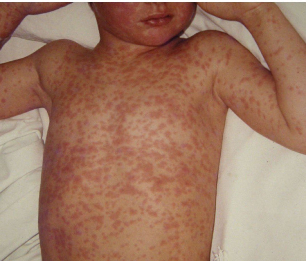 BREAKING😡: A kid just died from measles in Texas.

Why? Because some brain-dead, MAGA Facebook-doctor parents refused to vaccinate. This wasn’t an accident. It was a choice.

Measles was eradicated in the U.S. long time ago. The only reason it’s back is because of selfish,