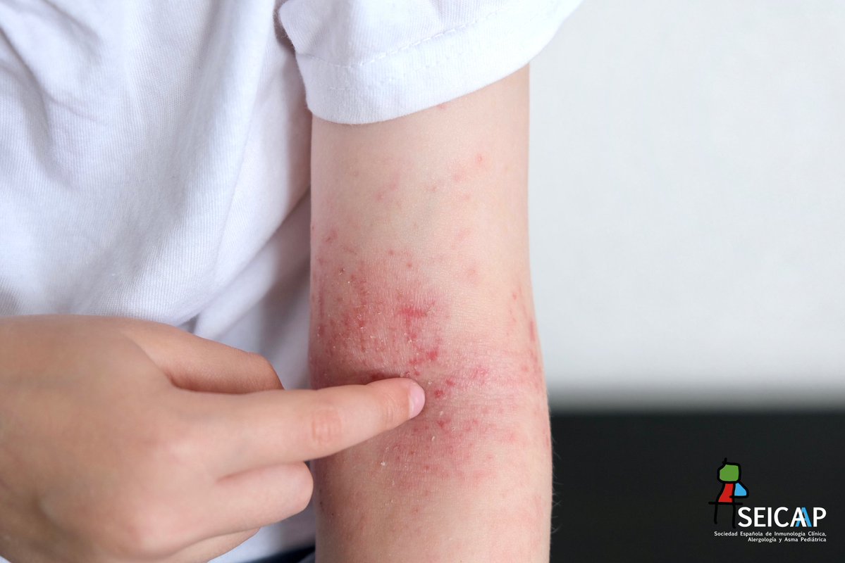 SEICAP's tweet photo. 🫧🧴Basar el tratamiento de dermatitis atópica exclusivamente en la hidratación es un error. Existen un grupo de pacientes con DA severa o grave que necesitan tratamientos más específicos o inmunológicos.   

https://t.co/bfW4pRKIIs https://t.co/G5MMMCi64n