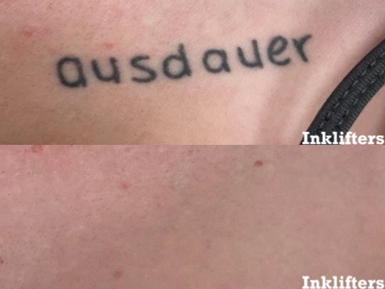 Before and after 7 tattoo removal treatments 🙌 Call or text us at (801) 785-8884 to book an appointment!
