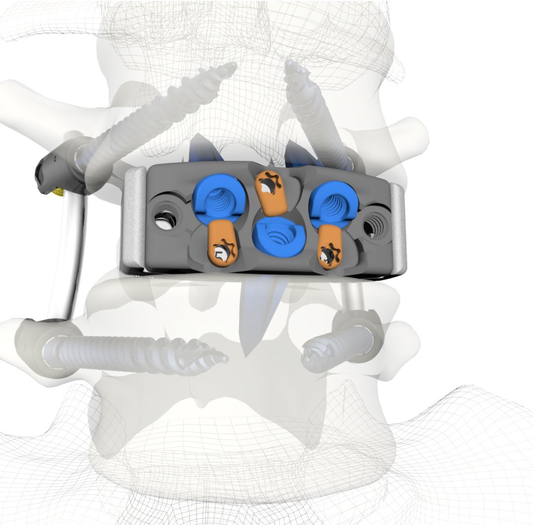 Zavation’s Varisync ALIF system - instagram.com/p/DGjMNYMBVDI/…

For product information, including indications, contraindications, warnings, precautions, potential adverse effect, and patient counseling information, see the package insert at zavation.com/ifu/