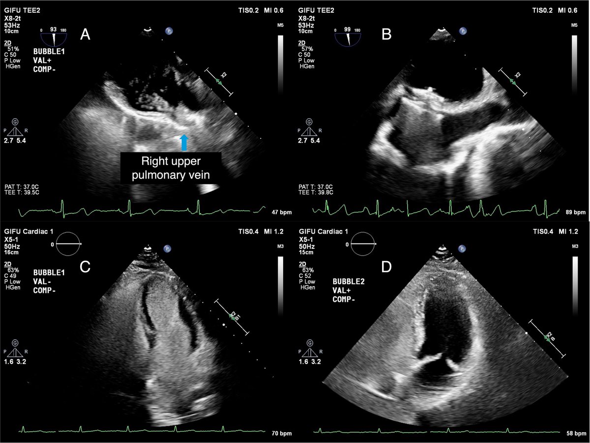 私たちのCase Reportが @EHJCaseReports に掲載されました！ PFOとPAVMを併存したCryptogenic Strokeの症例に対し、段階的な経皮的閉鎖術を実施しました。過去の報告もreviewしながらまとめています。
ご興味ある方はぜひご一読ください！
🔗academic.oup.com/ehjcr/article/…
#PFO #PAVM #CryptogenicStroke