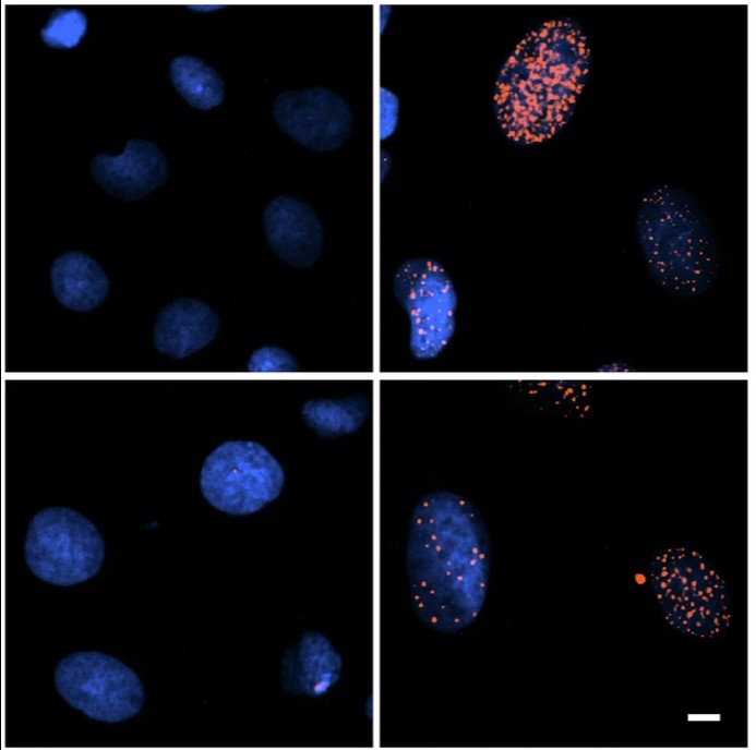 .<a href="/NUFeinbergMed/">Northwestern Feinberg School of Medicine</a> scientists designed a methodology for high-efficiency reprogramming of primary #BreastCancer cells and used it to generate #hiPSC lines from nine breast cancer patients.

👀 See for yourself: go.nature.com/3EZkari