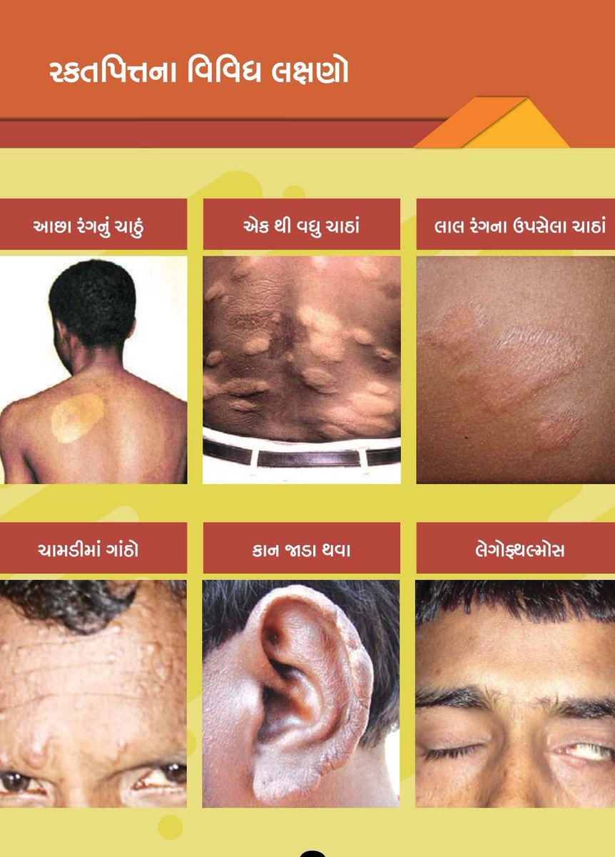 #Leprosy

✅ રક્તપિત્તના લક્ષણોની શરૂઆતમાં ખબર પડવાથી તેની સારવાર તરત જ કરી શકાય છે

✅ કોઈ પણ પ્રકારની વિકૃતિને આવતી રોકી શકાય છે

વધુ માહિતી માટે આરોગ્ય કેન્દ્રની મુલાકાતલો

@GujHFWDept
<a href="/NHMGujarat/">NHM Gujarat</a>
<a href="/InfoGujarat/">Gujarat Information</a>
<a href="/ddo_porbandar/">District Panchayat Porbandar</a>
<a href="/COLLECTORDWK/">Collector Devbhumi Dwarka</a>
<a href="/DdoDwarka/">District Panchayat DevbhumiDwarka</a>
<a href="/CDHO_Dwarka/">CDHO Devbhumi Dwarka</a>
<a href="/ThoBhanvad/">Tho Bhanvad</a>