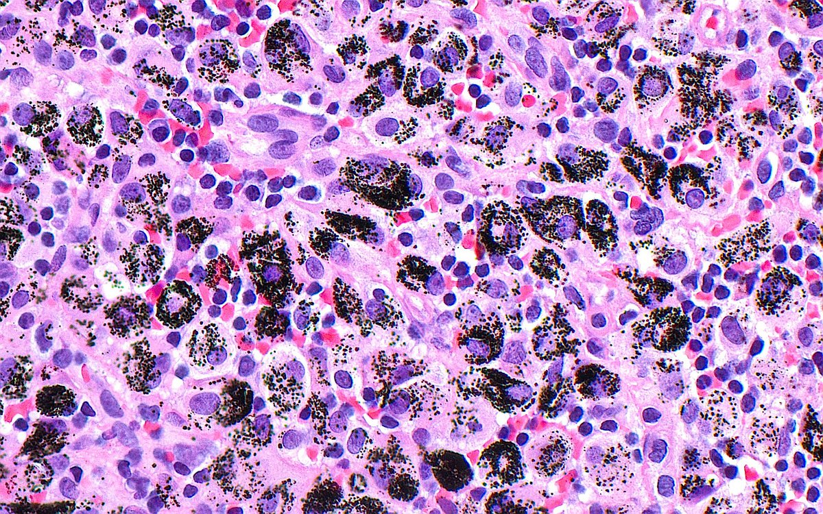 🔬 Anthracosis ~ Black pigment in macrophages in a mediastinal
