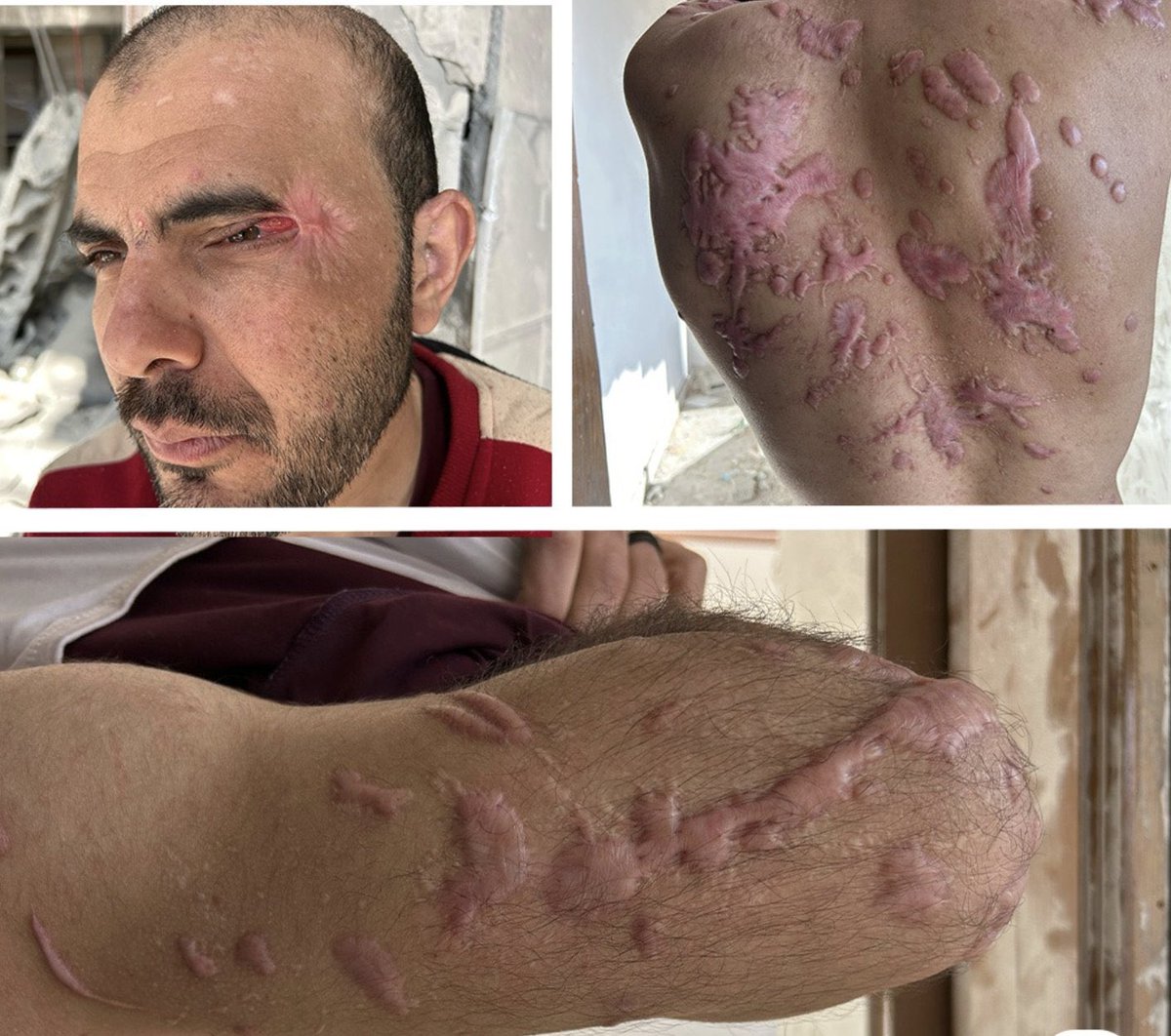 MosabAbuToha's tweet image. One Palestinian prisoner who was released yesterday evening. He was abducted from Gaza a year ago and was then subjected to torture, especially burning by chemicals. He lost sight in his left eye.