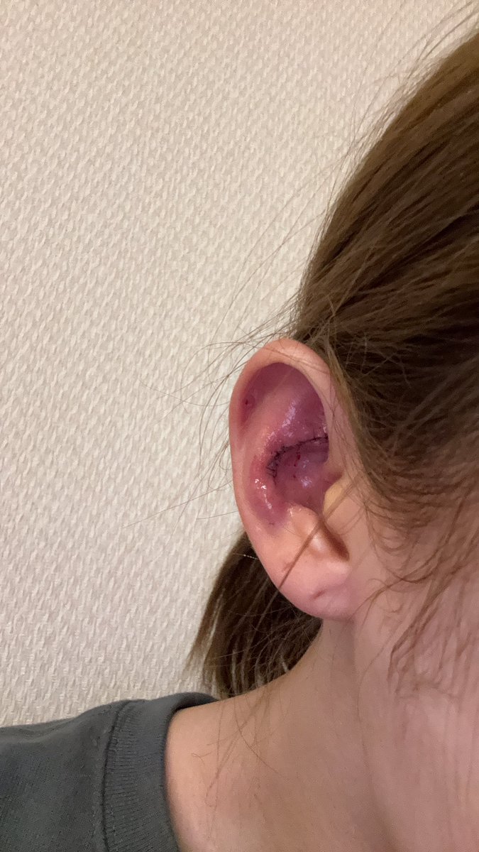 karatapi6513's tweet photo. 鼻の綿
片方は2日目に取ってくれたけど
もう片方7日後にとるって言われた
何事？🥹苦しくて死ぬ

耳痛い😂

鼻3度目
再手術
#トップフェイス #韓国旅行 #渡韓整形 #鼻フル #鼻DT #鼻尖形成 https://t.co/8r3iszRKiX