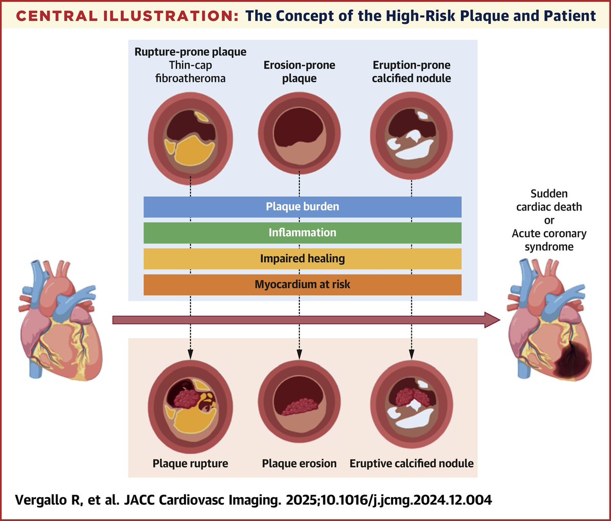 Rocco Vergallo (@roccovergallo) on Twitter photo “Vulnerable or High-Risk Plaque: A JACC Cardiovascular Imaging Position Statement” just published in <a href="/JACCJournals/">JACC Journals</a>
jacc.org/doi/10.1016/j.…
#atherosclerosis #vulnerableplaque #highriskplaque #imaging #OCT #IVUS #NIRS #deepOCT #CT #PCCT #MRI #lipid #lipidlowering #PCI #outcome “Vulnerable or High-Risk Plaque: A JACC Cardiovascular Imaging Position Statement” just published in <a href="/JACCJournals/">JACC Journals</a>
jacc.org/doi/10.1016/j.…
#atherosclerosis #vulnerableplaque #highriskplaque #imaging #OCT #IVUS #NIRS #deepOCT #CT #PCCT #MRI #lipid #lipidlowering #PCI #outcome