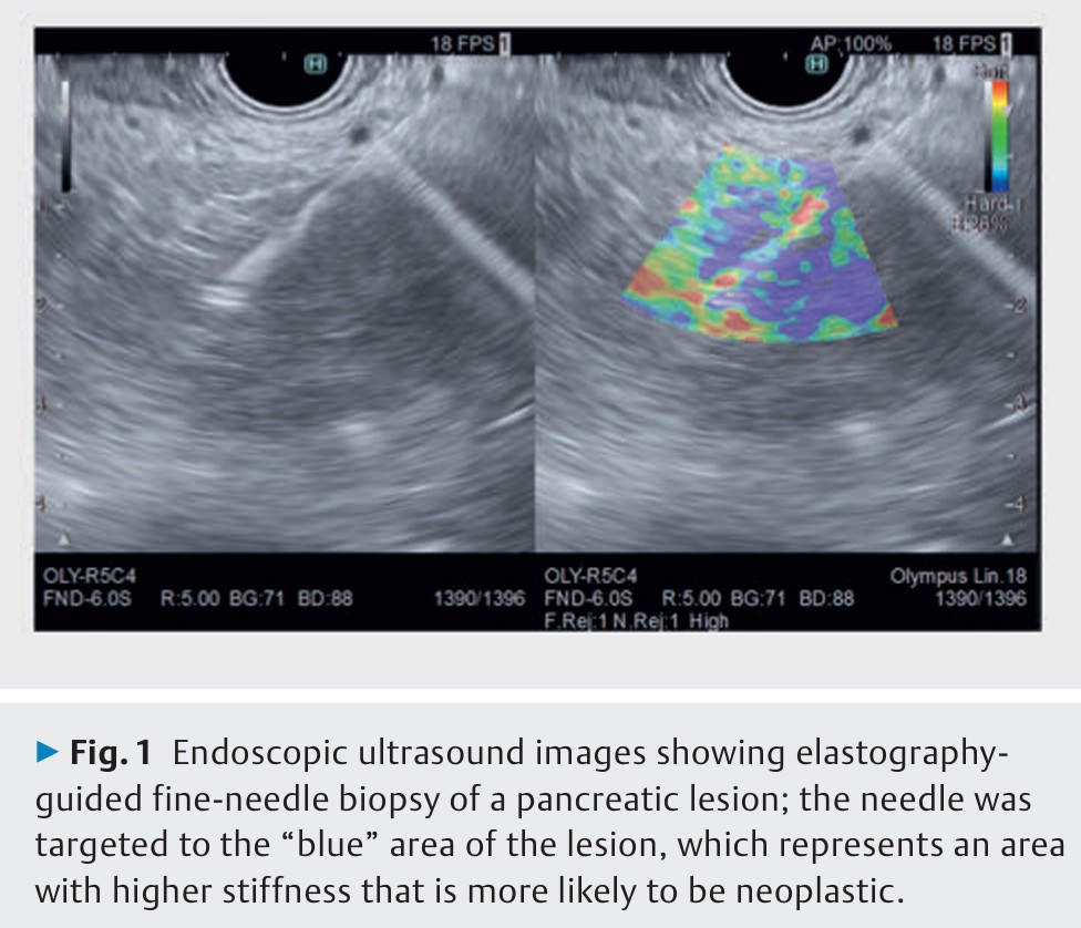 ESGE (@esge_news) on Twitter photo 15 evidence-based statements with GRADE appraisal of the quality of evidence, covering all aspects of tissue sampling of several GI solid lesions & pancreatic cysts = vital reading. Congratulations to <a href="/AntonioFaccior6/">Antonio Facciorusso</a> (pictured below), Marianna Arvanitaki, <a href="/CrinoStefano/">Stefano Francesco Crinó</a> et al 15 evidence-based statements with GRADE appraisal of the quality of evidence, covering all aspects of tissue sampling of several GI solid lesions & pancreatic cysts = vital reading. Congratulations to <a href="/AntonioFaccior6/">Antonio Facciorusso</a> (pictured below), Marianna Arvanitaki, <a href="/CrinoStefano/">Stefano Francesco Crinó</a> et al