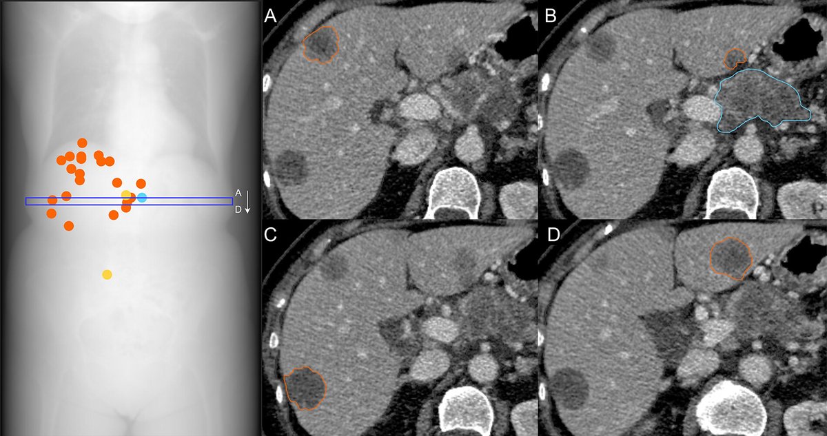 📰 This study published in <a href="/radiology_rsna/">Radiology</a>, led by researchers from <a href="/GustaveRoussy/">Gustave Roussy</a>, aimed to evaluate tumor fraction (TF) in liquid biopsy as a potential surrogate for total tumor volume (TTV) measured on CT across 1,065 patients with metastatic cancer.

🔗doi.org/10.1148/radiol…