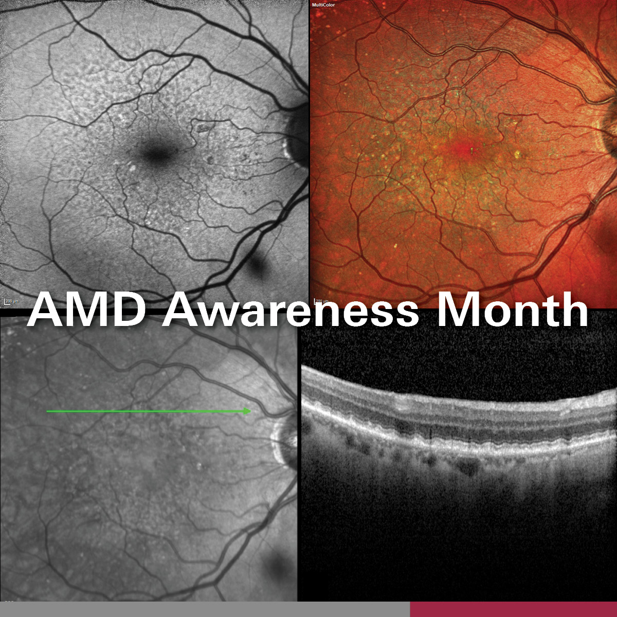 February is Age-Related Macular Degeneration Awareness Month 👁️

At Heidelberg Engineering Ltd., we are dedicated to providing advanced imaging technology that helps eye care professionals detect, monitor, and manage AMD with accuracy and confidence.

ow.ly/oQ8B50V5ViF