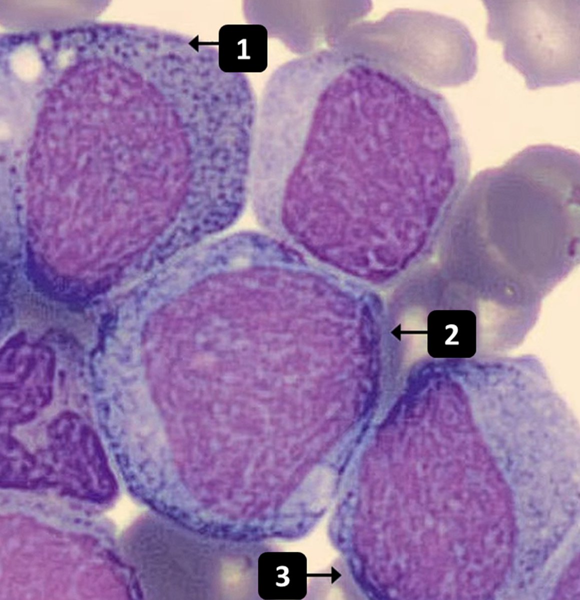 Charles Herndon (@drcyclopath) on Twitter photo 3 cells, can you get them all right!? 
What is cell #1? 
A) Myeloblast 
B) Promyelocyte
C) Myelocyte
D) Metamyelocyte
#HemePath #Hematology #pathology #PathTwitter 3 cells, can you get them all right!? 
What is cell #1? 
A) Myeloblast 
B) Promyelocyte
C) Myelocyte
D) Metamyelocyte
#HemePath #Hematology #pathology #PathTwitter