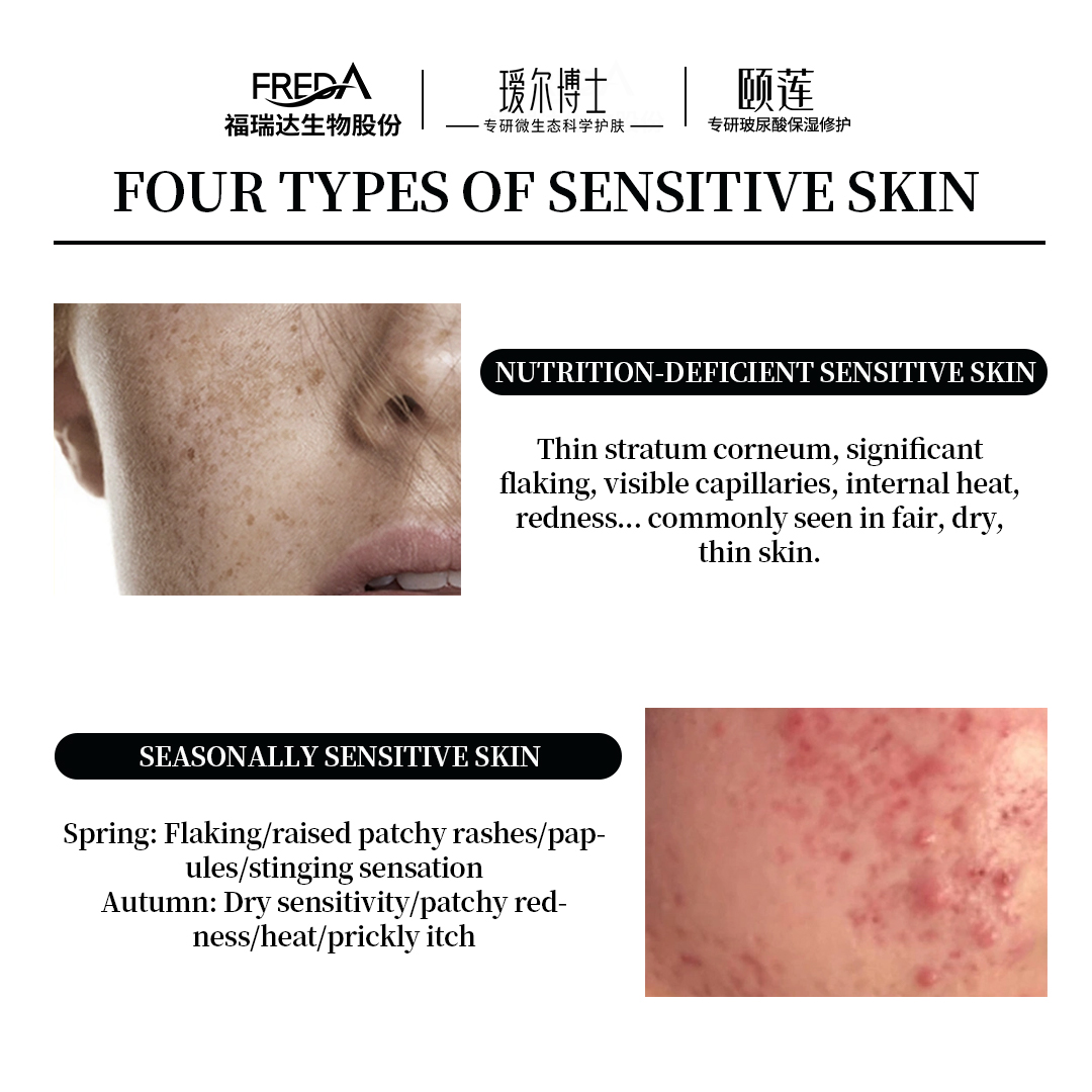 thefredabio's tweet image. Did you know there are four main types of sensitive skin? Whether it’s dryness, redness, irritation, or reactivity, your skin deserves the best care! 💆‍♀️✨

At Dr. Alva and Rellet, we’ve crafted solutions tailored to each unique concern.
#DrAlva #Rellet #SensitiveSkinSolutions