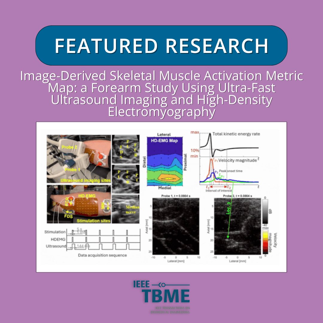 IEEEembs's tweet image. Discover a new method to map skeletal muscle activation using ultra-fast ultrasound imaging and HD-EMG. 

This innovative approach offers a non-invasive way to study muscle function and recovery. 

Learn more here: bit.ly/3QasaId

#MuscleActivation #MuscleFunction…